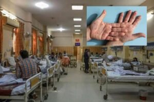 Mpox virus KP, mpox virus, monkey pox virus kp, mpox virus cases kp latest