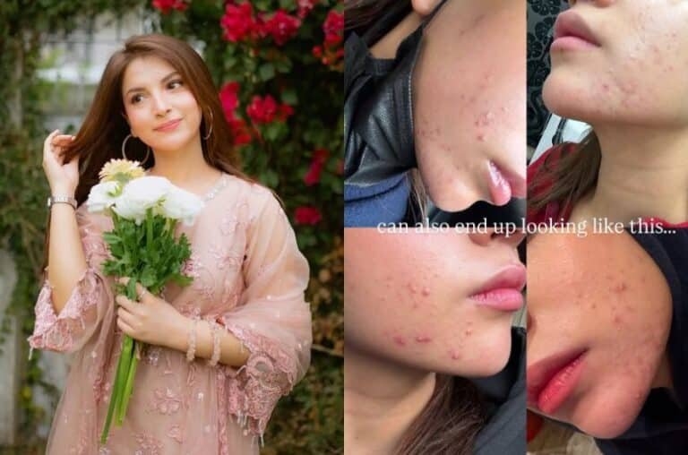 Dananeer Mobeen’s pictures go viral as she opens up about skin problems