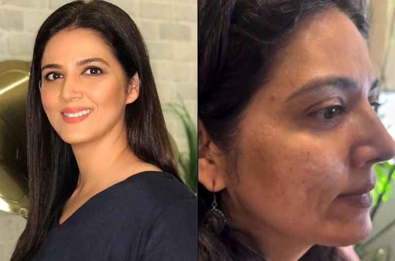 Savera Nadeem acne treatment, Savera nadeem, savera nadeem acne, savera nadeem acne look