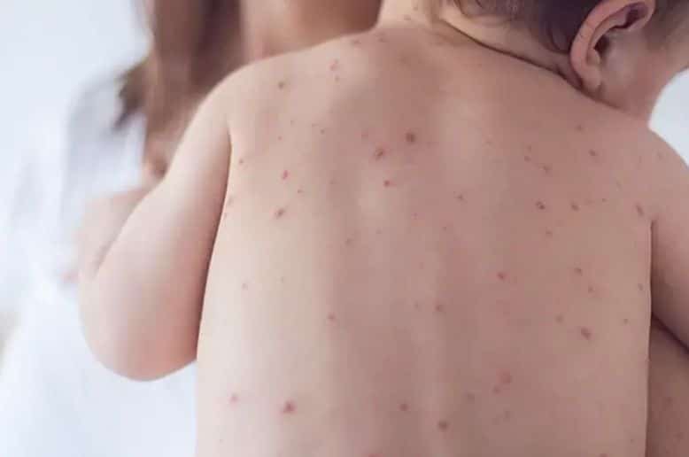 Sindh faces growing health crisis amid worsening measles outbreak