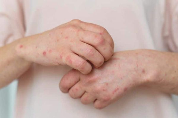 Monkeypox Case Reported in Karachi