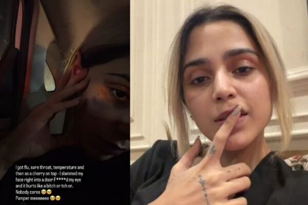 Aima Baig’s door accident leaves her with painful bruise